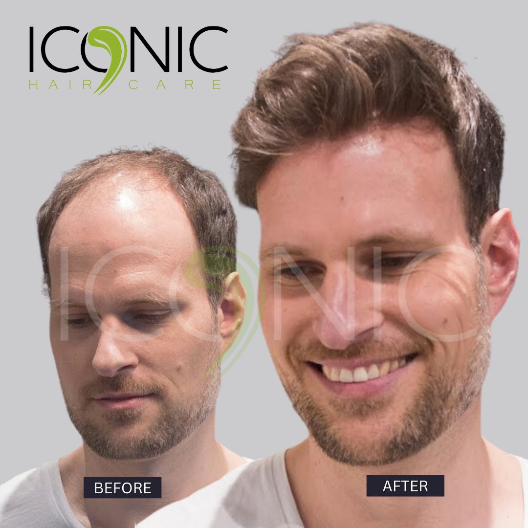 نتيجة قبل وبعد من ICONIC Hair Care 4