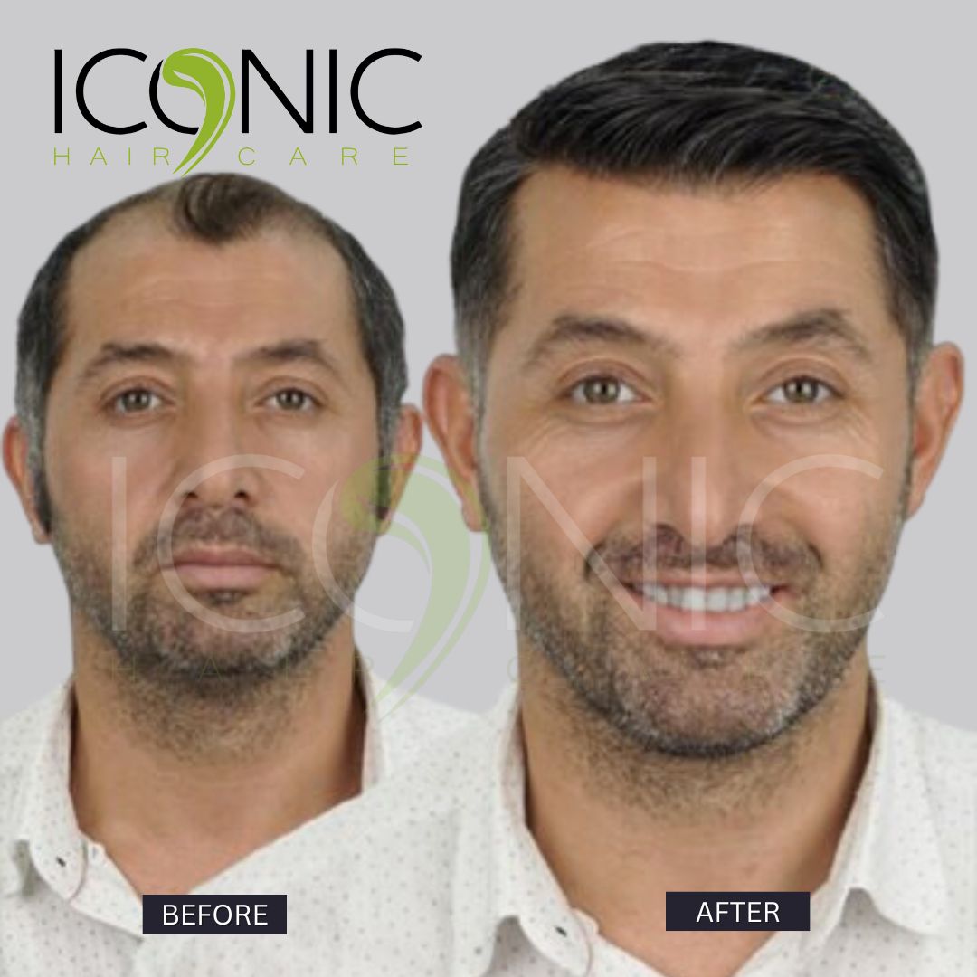 نتيجة قبل وبعد من ICONIC Hair Care 2