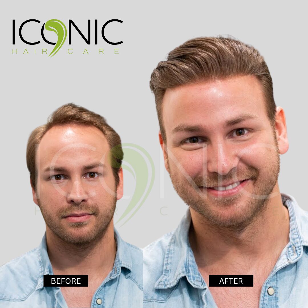 نتيجة قبل وبعد من ICONIC Hair Care 11
