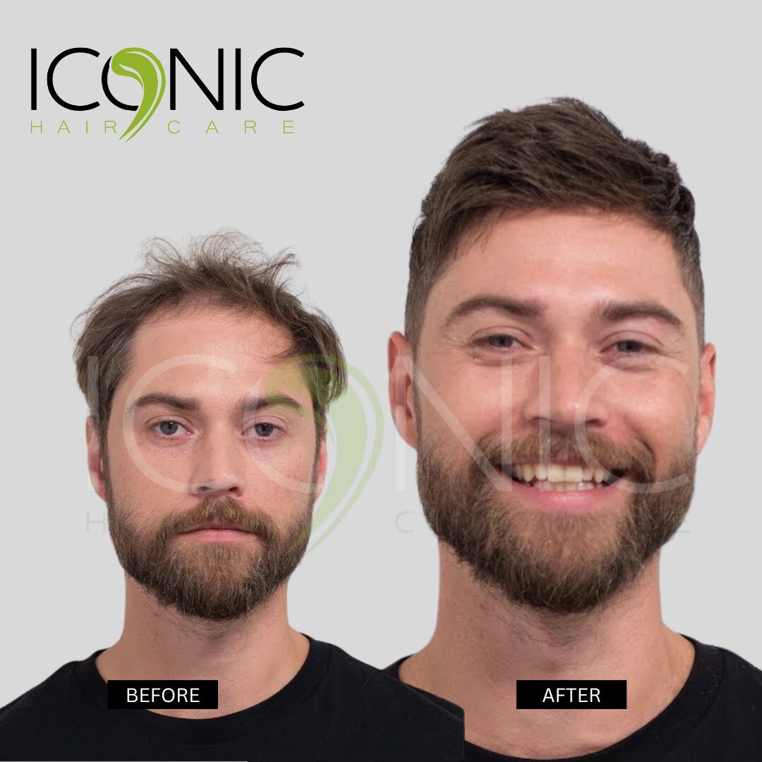 نتيجة قبل وبعد من ICONIC Hair Care 12
