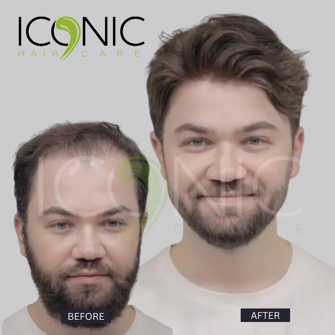 Men hair replacement result 1