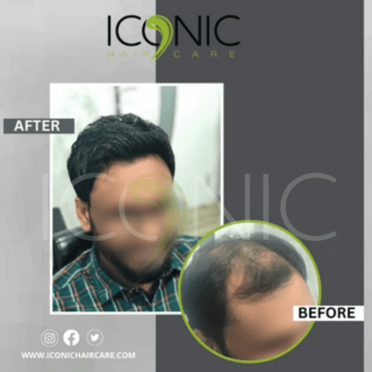 Men hair replacement result 2