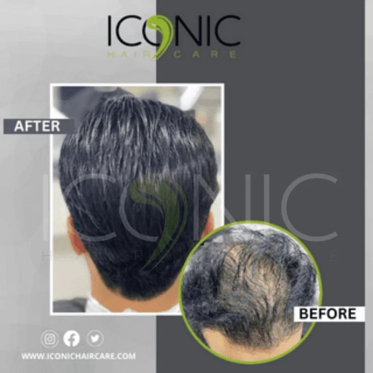 Men hair replacement result 3