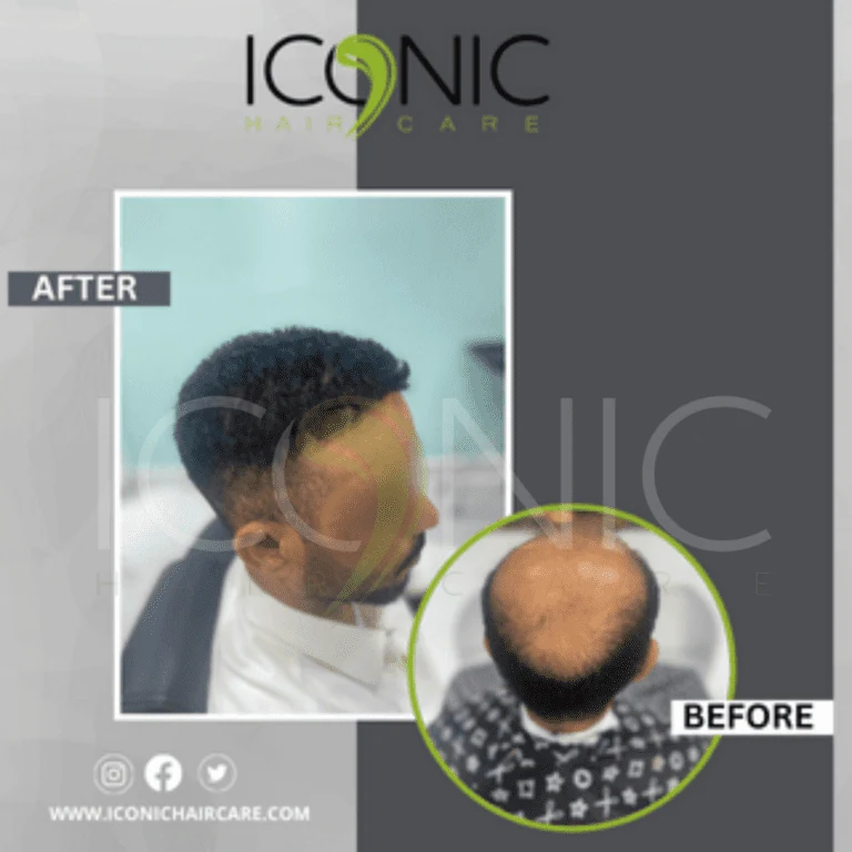 Men hair replacement result 4