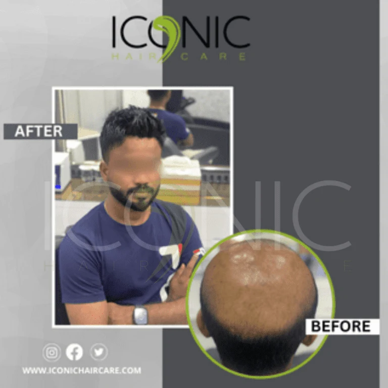 Men hair replacement result 5