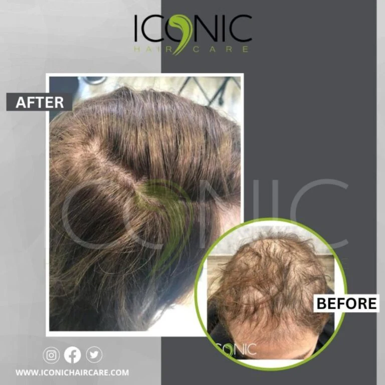 Women hair replacement result 1