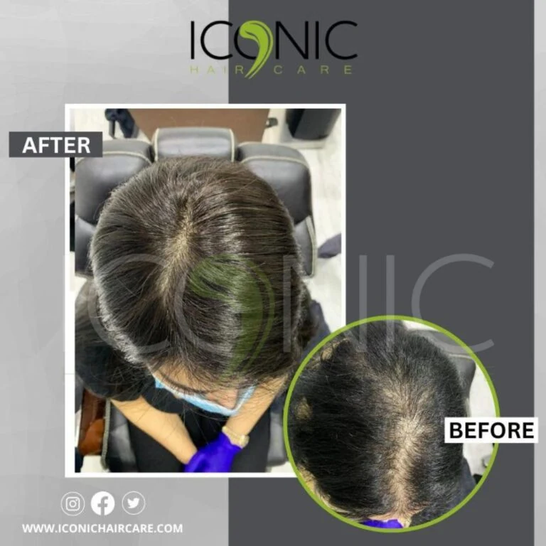 Women hair replacement result 2
