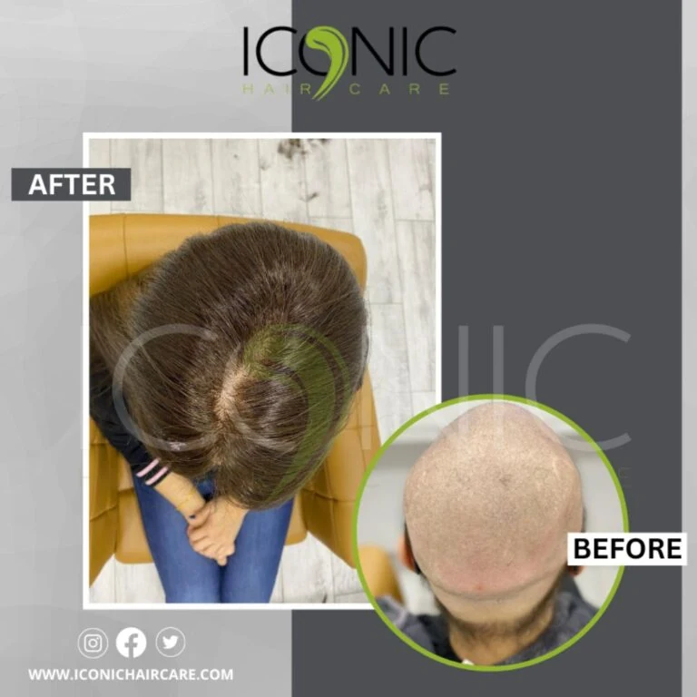 Women hair replacement result 3