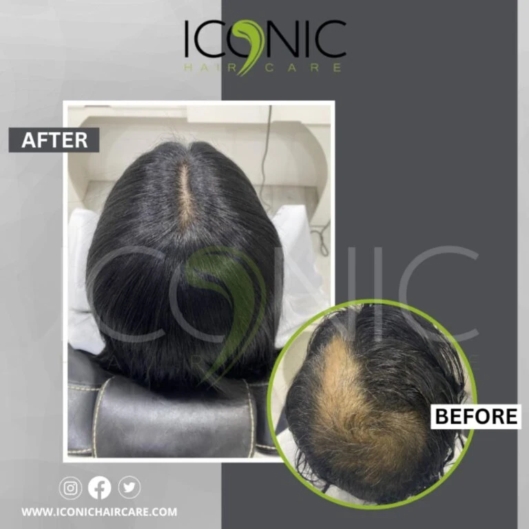 Women hair replacement result 4